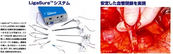 縫合糸反応性肉芽腫への対応について