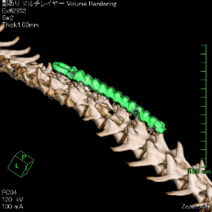 脊髄減圧術ならびにプレート固定を実施した脊椎骨折・脱臼症例