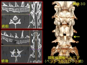 頚部椎間板ヘルニア減圧手術